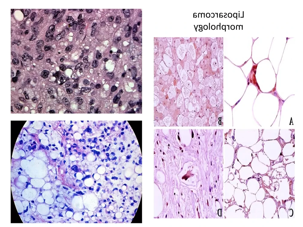 Medical illustration of a lump under the skin