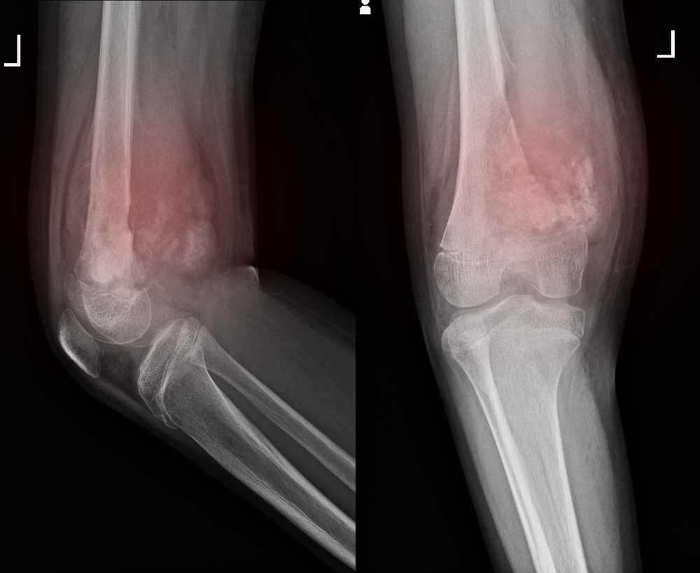 Simple chart-style graphic representing cancer statistics